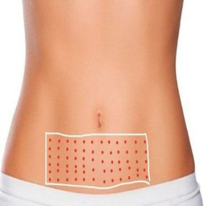 Hyaluron Pen Body Contour Training