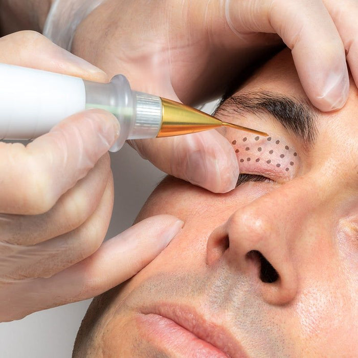 Plasma Pen Fibroblast Training demo featuring technician applying plasma device to client’s under-eye area for non-surgical skin tightening.