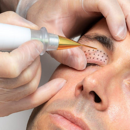 Plasma Pen Fibroblast Training demo featuring technician applying plasma device to client’s under-eye area for non-surgical skin tightening.