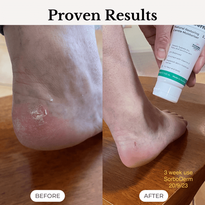 SorboDerm Natural Restoring Gentle Moisturiser for eczema and psoriasis