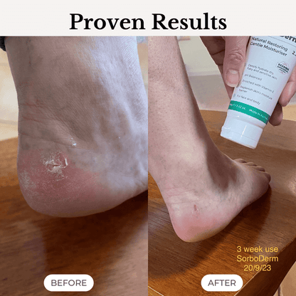 SorboDerm Natural Restoring Gentle Moisturiser for eczema and psoriasis