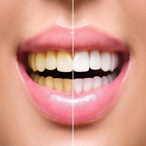 Teeth Whitening Training